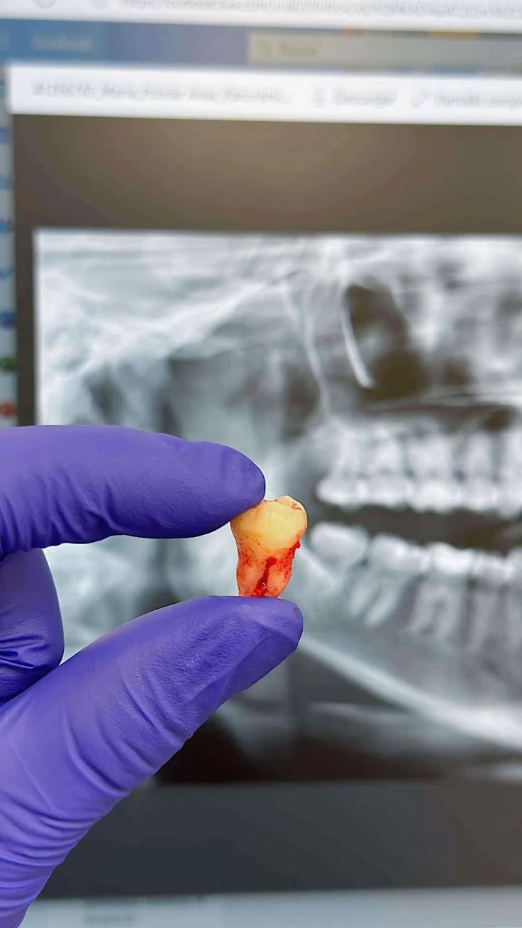 Extracted tooth held during an oral surgery procedure