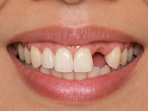 Patient's smile before treatment in Smile Story 03, showing a gap where a tooth is missing
